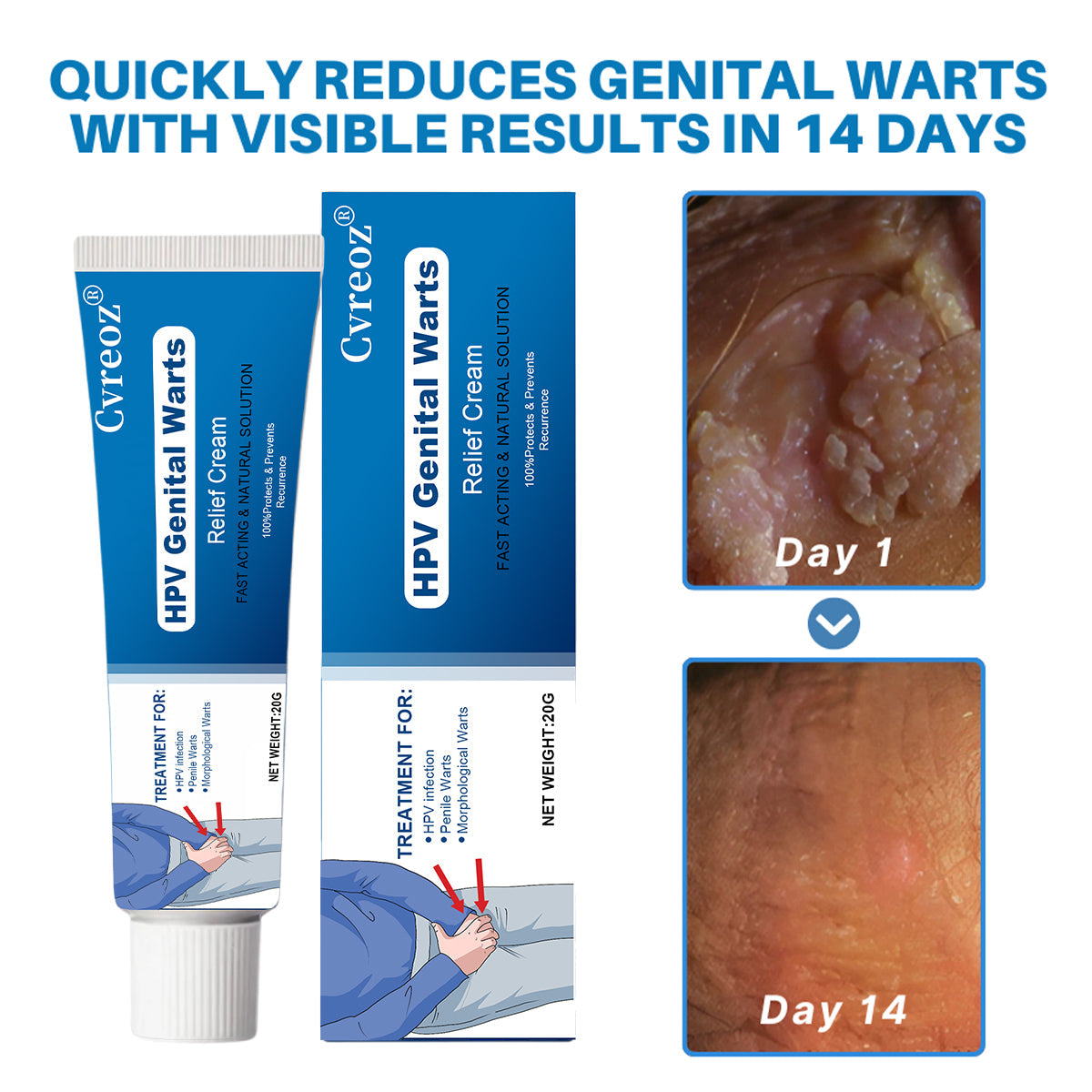 Cvreoz® HPV Genital Warts Relief Cream