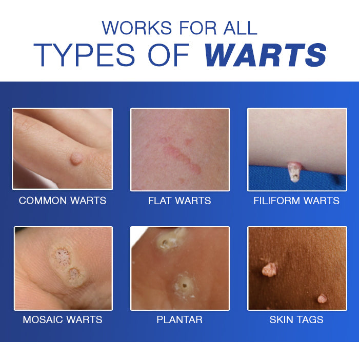 Cvreoz® Wart Eraser Pro
